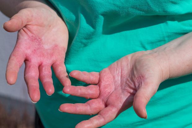 Dermatitis
