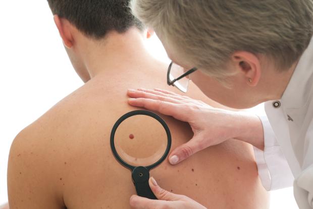 Dermatologist examines a mole